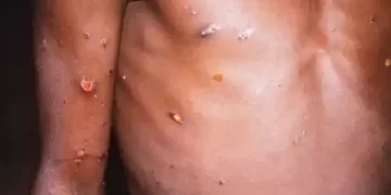 Variole du singe: 1 400 cas recensés dans 7 pays africains
