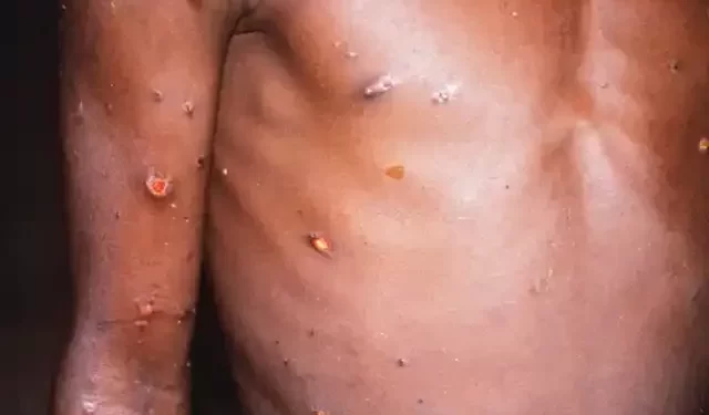 Variole du singe: 1 400 cas recensés dans 7 pays africains