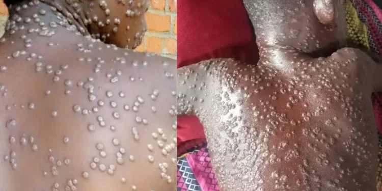 Sierra Leone : Plus de 5000 cas de variole du singe dont 46 décès